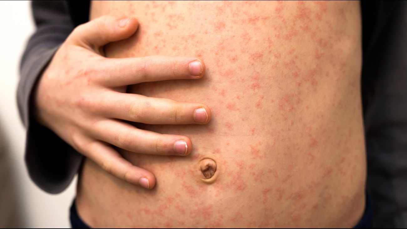 Nieuws - GGD: 'Familievakantie oorzaak van mazelenuitbraak op Almeerse basisschool'